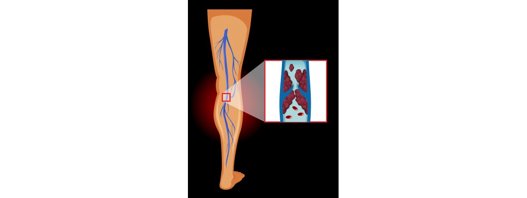 वैरिकोज वेन्स की होम्योपैथी दवा — Homeopathy Medicines For Varicose Vein in Hindi वैरिकोज वेन्स की होम्योपैथी दवा — Homeopathy Medicines For Varicose Vein in Hindi