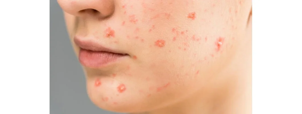 Homeopathy Medicine For Acne And Pimples: Natural Remedies for Clearer, Healthier Skin