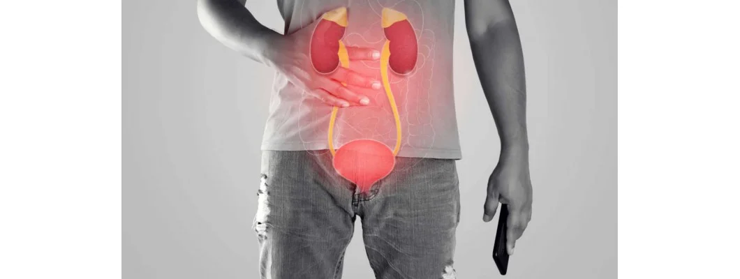 Top 5 Homeopathy Medicines For Kidney Stone Treatment