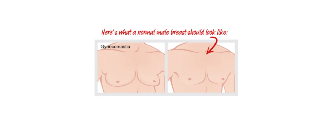 Is there any medicine in homeopathy for Gynecomastia?
