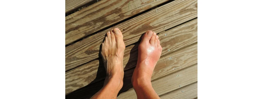 Homeopathy For Gout Treatment - Get Relief Today!