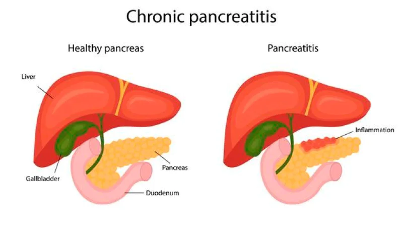 Homeopathy Treatment for ACUTE PANCREATITIS Homeopathy Treatment for ACUTE PANCREATITIS