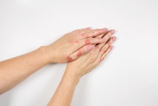 Homeopathy Therapy for Ringworm