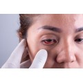 Homeopathic Medicine for Conjunctivitis