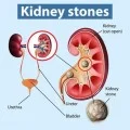 Homeopathic Medicine for Kidney Stones