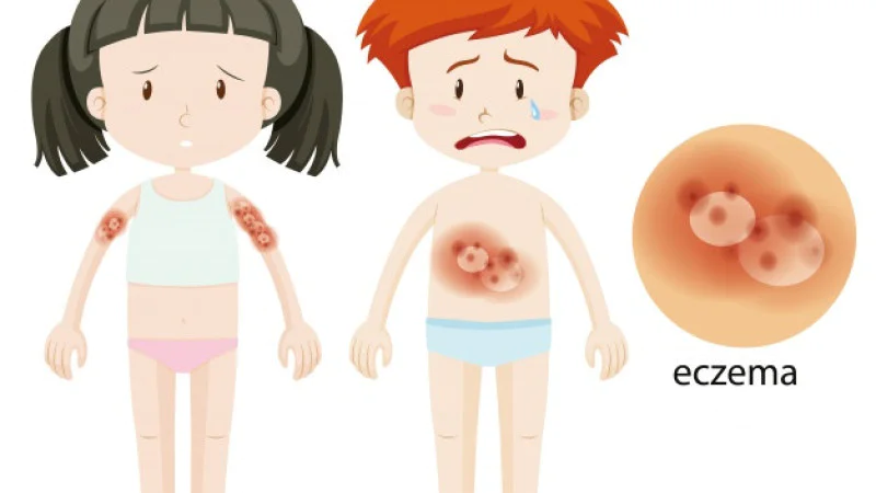 Homeopathic Medicines for Eczema Homeopathic Medicines for Eczema