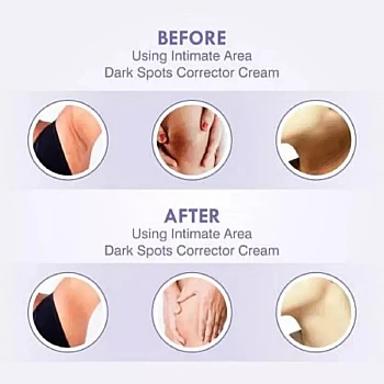 Skiura Nature Intimate Area Dark Spots Corrector Cream (50g)