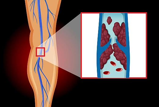 वैरिकोज वेन्स की होम्योपैथी दवा — Homeopathy Medicines For Varicose Vein in Hindi