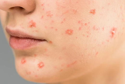 Homeopathy Medicine For Acne And Pimples: Natural Remedies for Clearer, Healthier Skin