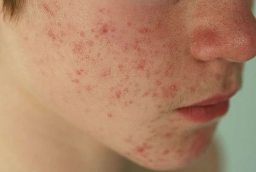 How Homeopathy Helps In Treating Skin Conditions like Melasma and Fungal Infections