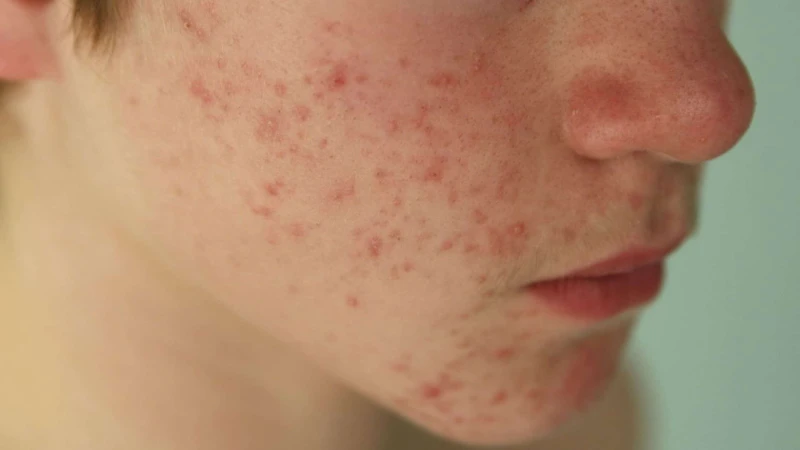 How Homeopathy Helps In Treating Skin Conditions like Melasma and Fungal Infections How Homeopathy Helps In Treating Skin Conditions like Melasma and Fungal Infections