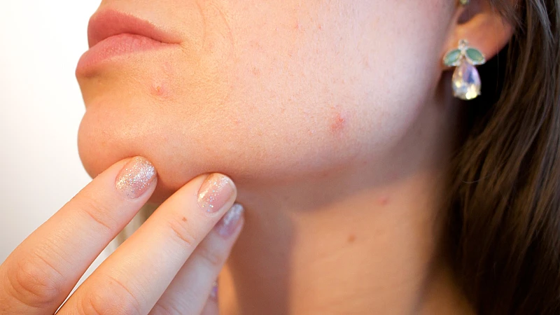 Best Homeopathic Medicines for Acne