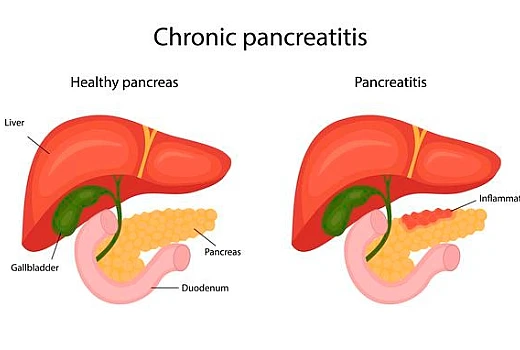 Homeopathy Treatment for ACUTE PANCREATITIS