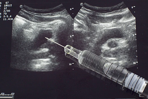 Reckeweg Aalserum 7x: Uses, Benefits, Side Effects and Dosages