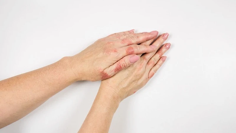 Homeopathy Therapy for Ringworm