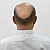 Homeopathic Medicine for Alopecia & Bald Patches