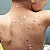 Homeopathic Medicine for Chikungunya Homeopathic Medicine for Chikungunya