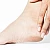 Homeopathic Medicine for Cracked Heels