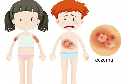 Homeopathic Medicines for Eczema