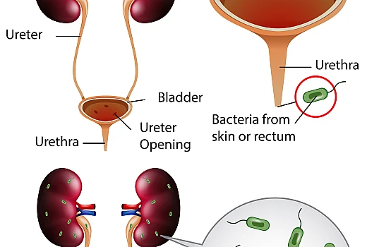Urinary Tract Infection causes symptoms and Homeopathic medicine Hindi