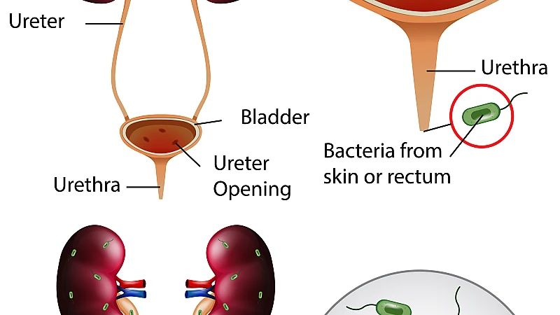 Urinary Tract Infection causes symptoms and Homeopathic medicine Hindi
