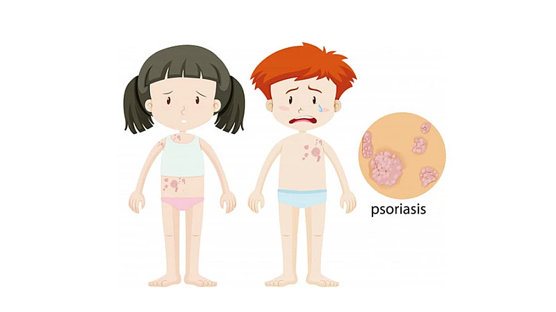 Is there any Cure for Psoriasis in Homeopathy?