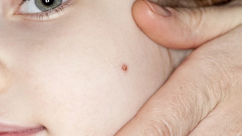 SBL Thuja Ointment- the Best Homeopathy Ointment to Treat Corn and Wart