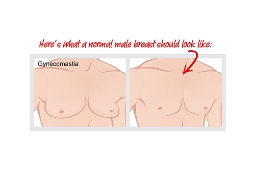 Is there any medicine in homeopathy for Gynecomastia?