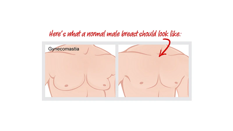 Is there any medicine in homeopathy for Gynecomastia? Is there any medicine in homeopathy for Gynecomastia?