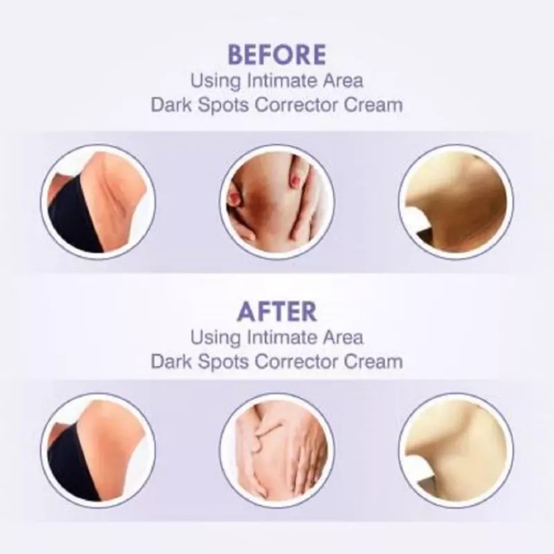 Skiura Nature Intimate Area Dark Spots Corrector Cream (50g)