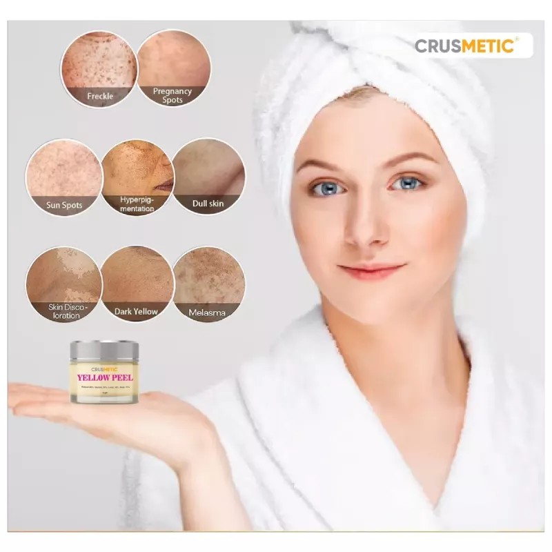 Crusmetic Yellow Peel + Neutralizer Solution + Disifected Cotton Swab Stick (15gm + 30ml + 4pcs Stick) (1Pack)