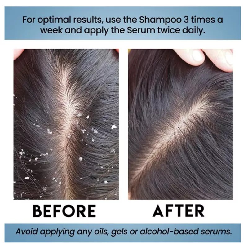 Lio Cosmeds Ph Glo Anti Dandruff Shampoo With Conditioner + Ph Glo Hair Serum (Shampoo 100ml + Serum 60ml) (1Pack)