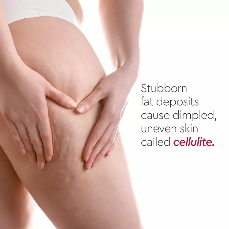 VLCC Clinic Prosculpt Cellulite Reduction Gel (90g)