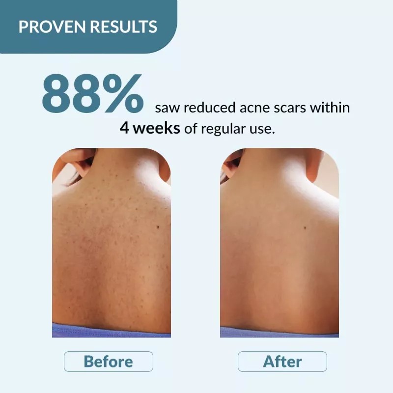 Fixderma Salyzap For Body Acne Body Wash (200ml)