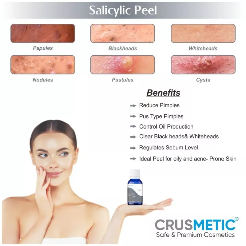 Crusmetic Salicylic 30% Peel + Neutralizer Solution + Brush+ Disifected Cotton Swab Stick (10ml + 30ml + 1 brush + 2 pcs Stick) (1Pack)