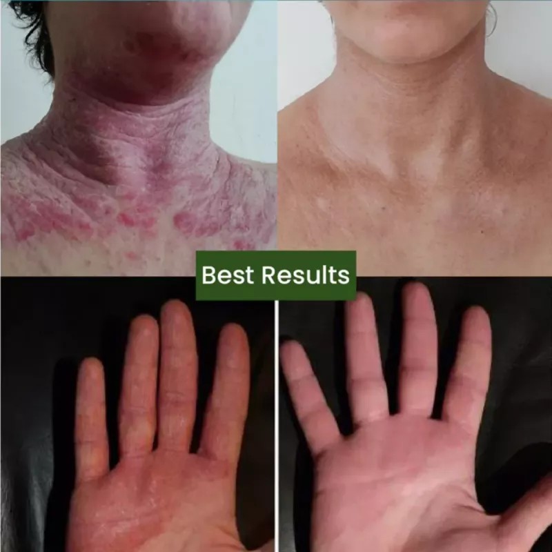 Cipzer Eczema Total Skin (60cap, Pack of 2)