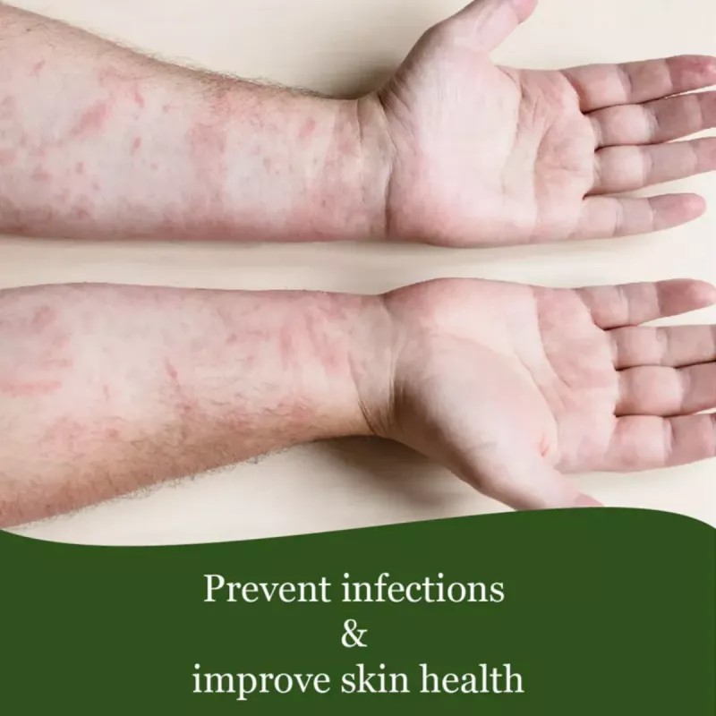 Cipzer Eczema Total Skin (60cap, Pack of 2)